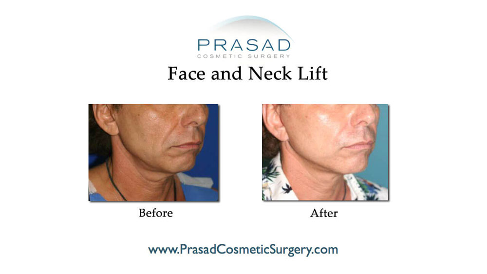 before and after cosmetic surgery male patient