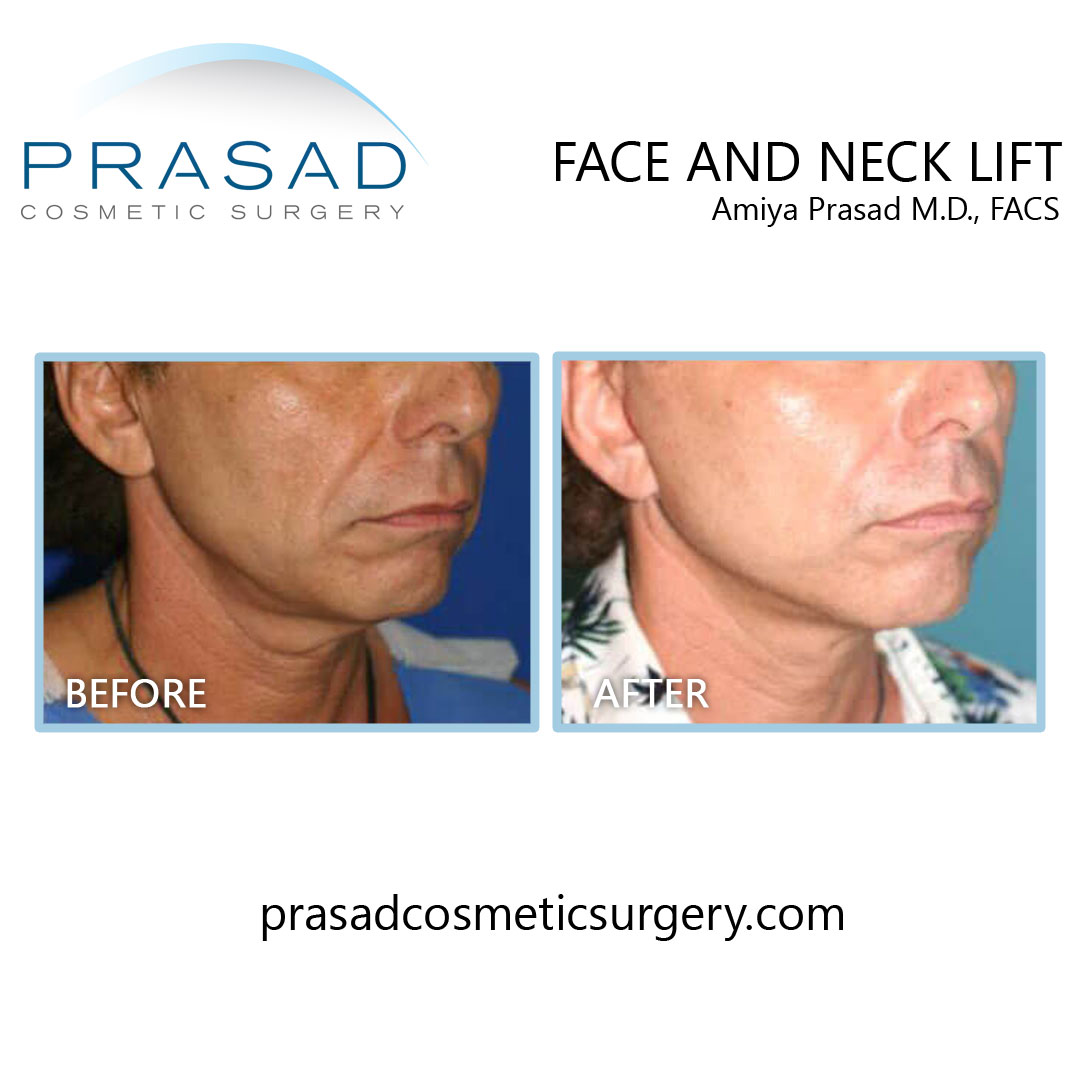 male facelift surgery before and after results