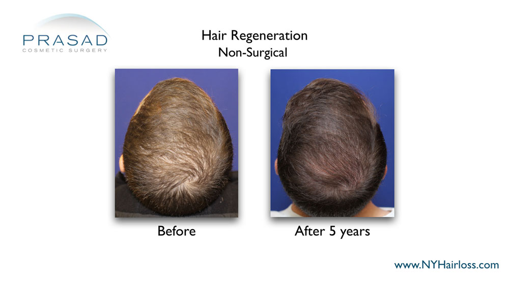 5 year results from Hair Regeneration male 20s top of scalp view with relevant information performed by Dr Amiya Prasad