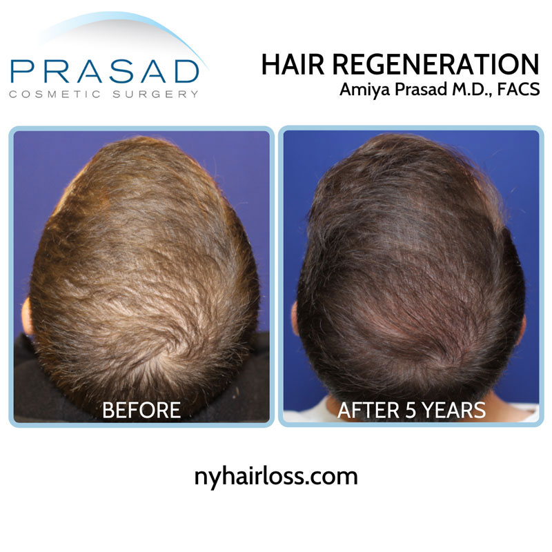 5 year results from Hair Regeneration male 20s top of scalp view with relevant information performed by Dr Amiya Prasad