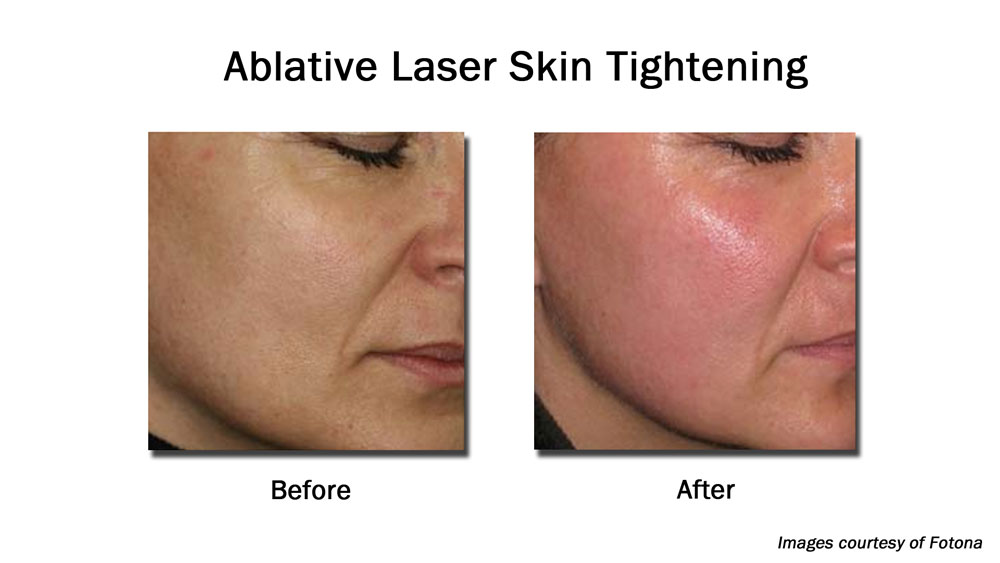 before and after Ablative laser facial resurfacing / facial skin tightening