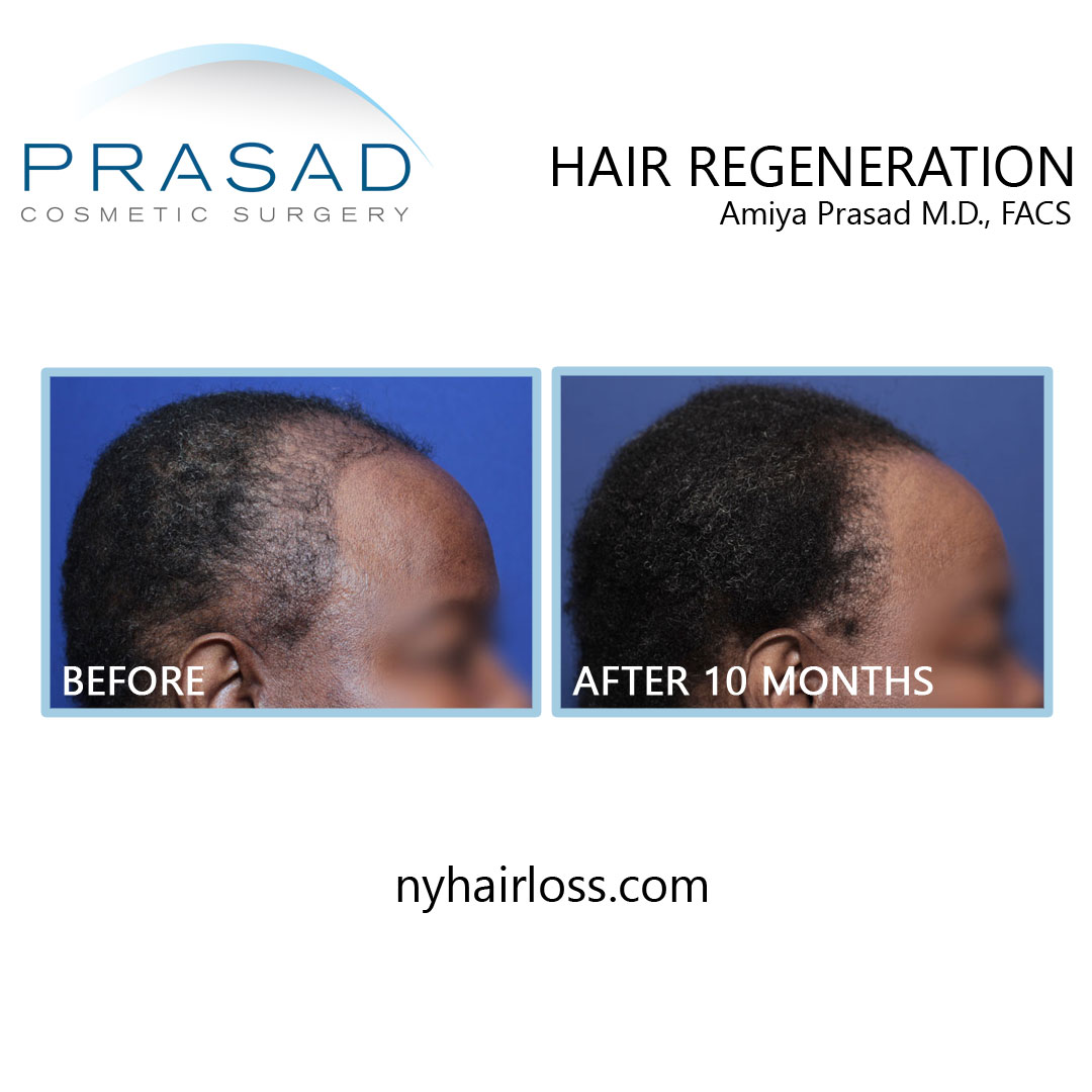 hair loss treatment for african american hair