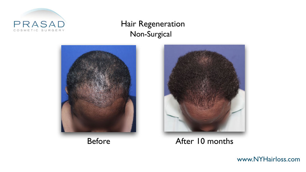 female hair loss treatment for african american hair