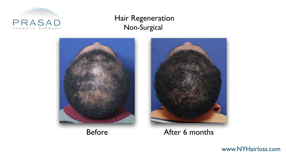 black female hair loss treatment before and after