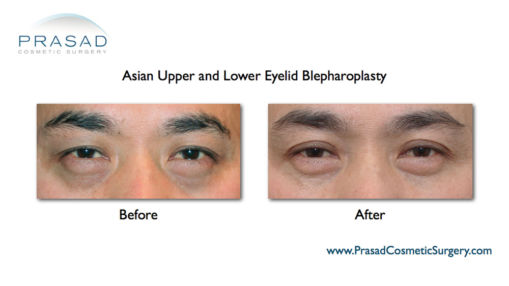 male asian eyelid surgery before and after