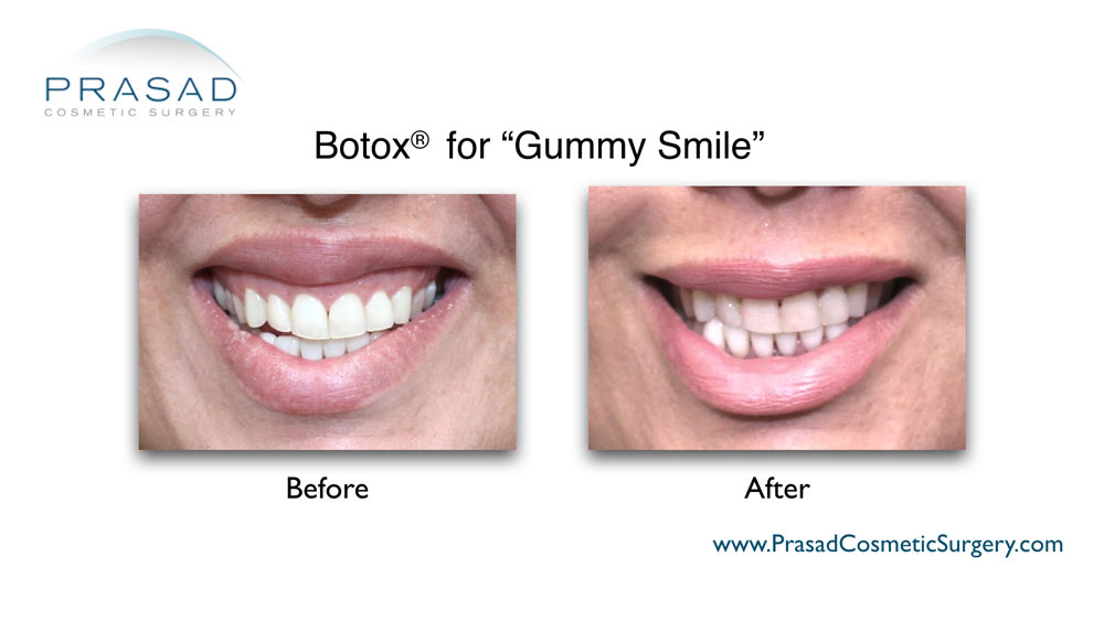 before and after using Botox for gummy smile