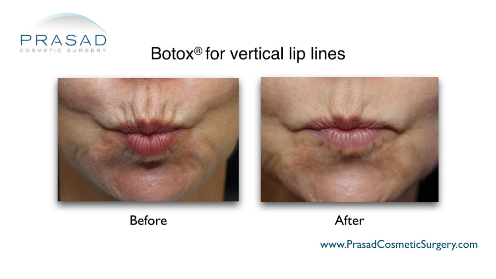 botox for lip lines before and after