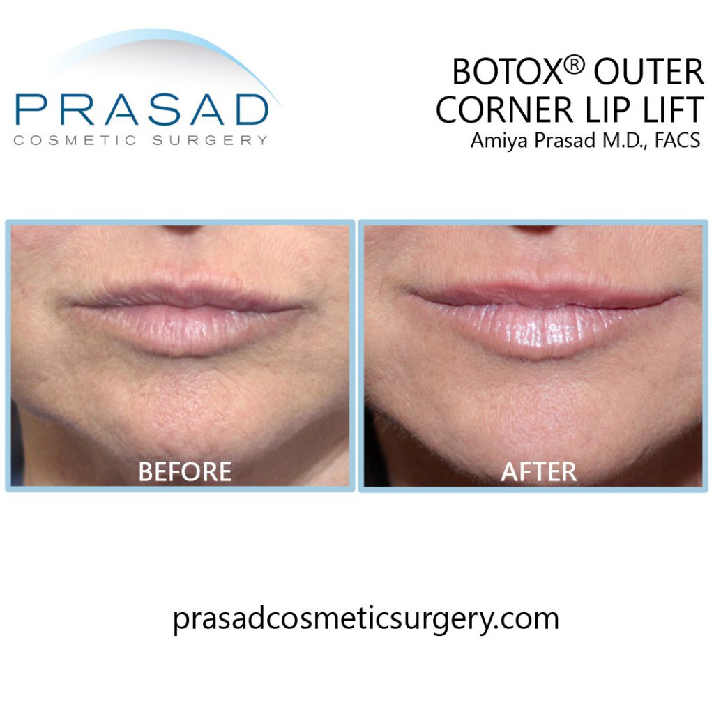 botox lip lift before and after