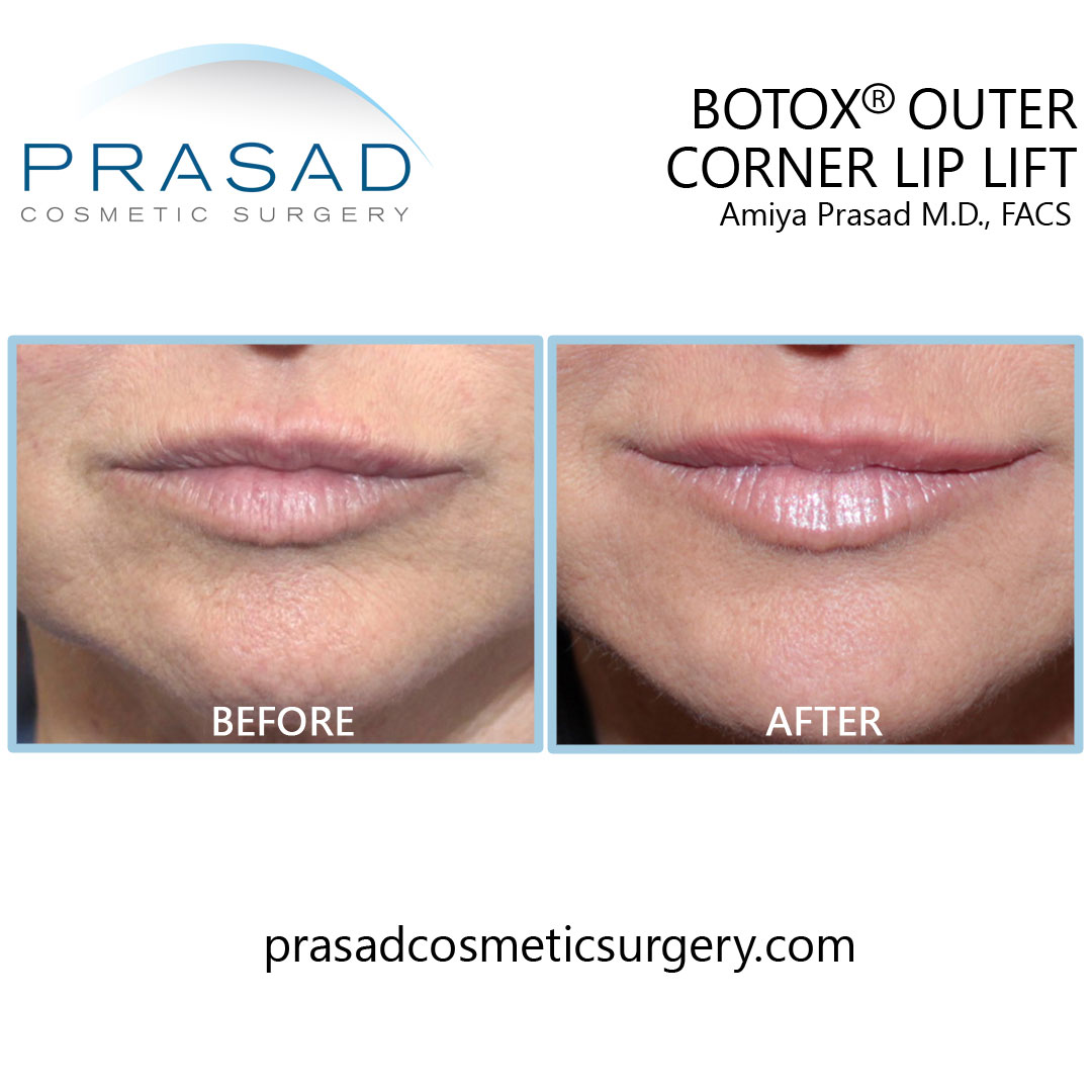 botox lip lift before and after