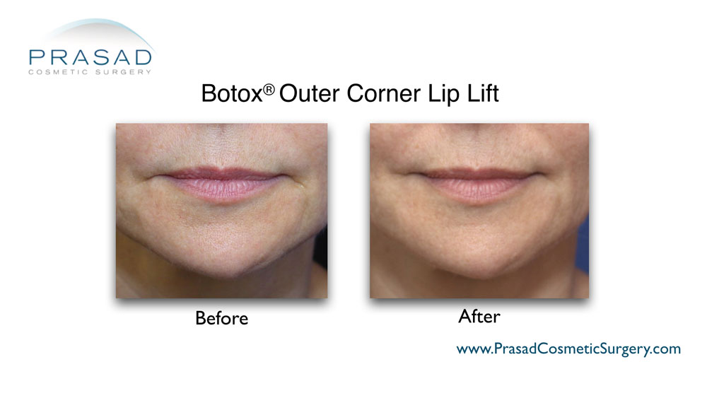 botox lip lift before and after - female patient