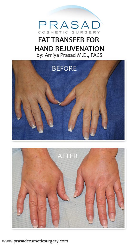 fat transfer to hand before and after