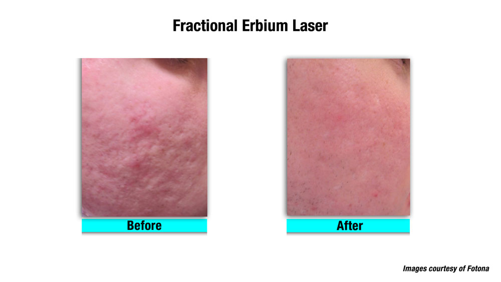 fractional laser before and after acne scars