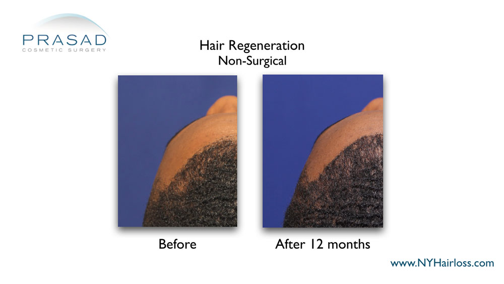 acell + PRP treatment for black hair before and after
