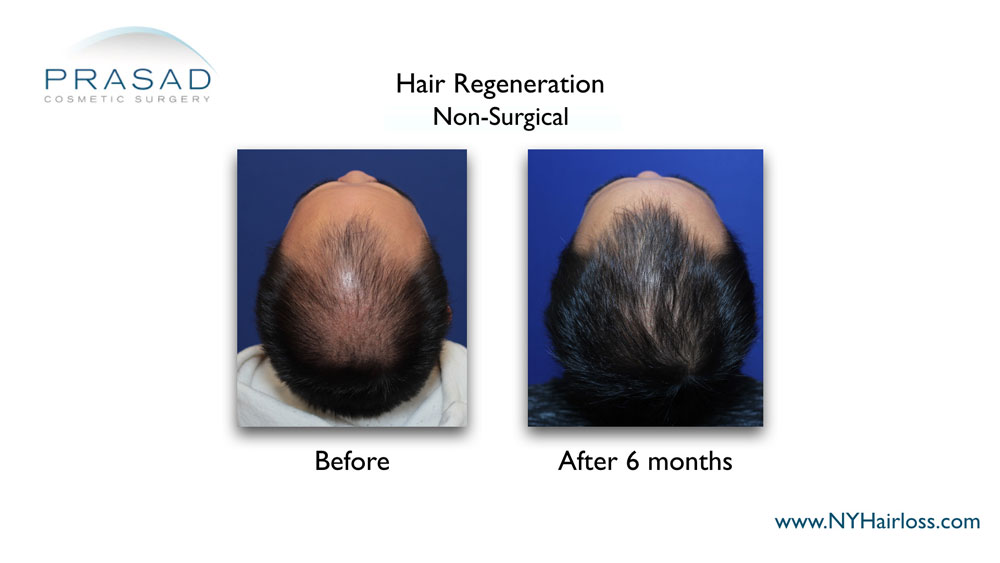hair regrowth treatment for men before and after