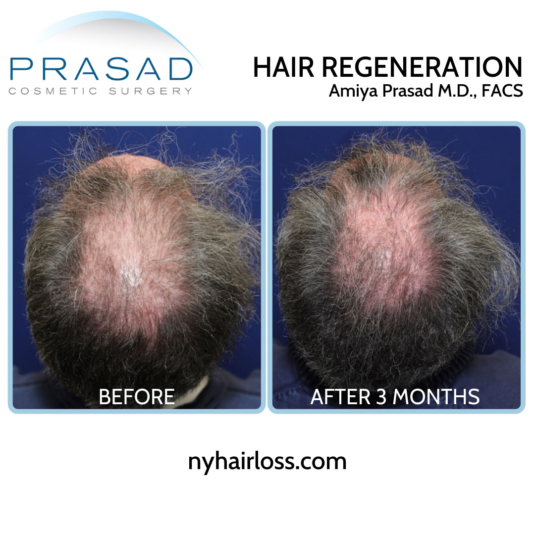 before and after male pattern baldness treatment