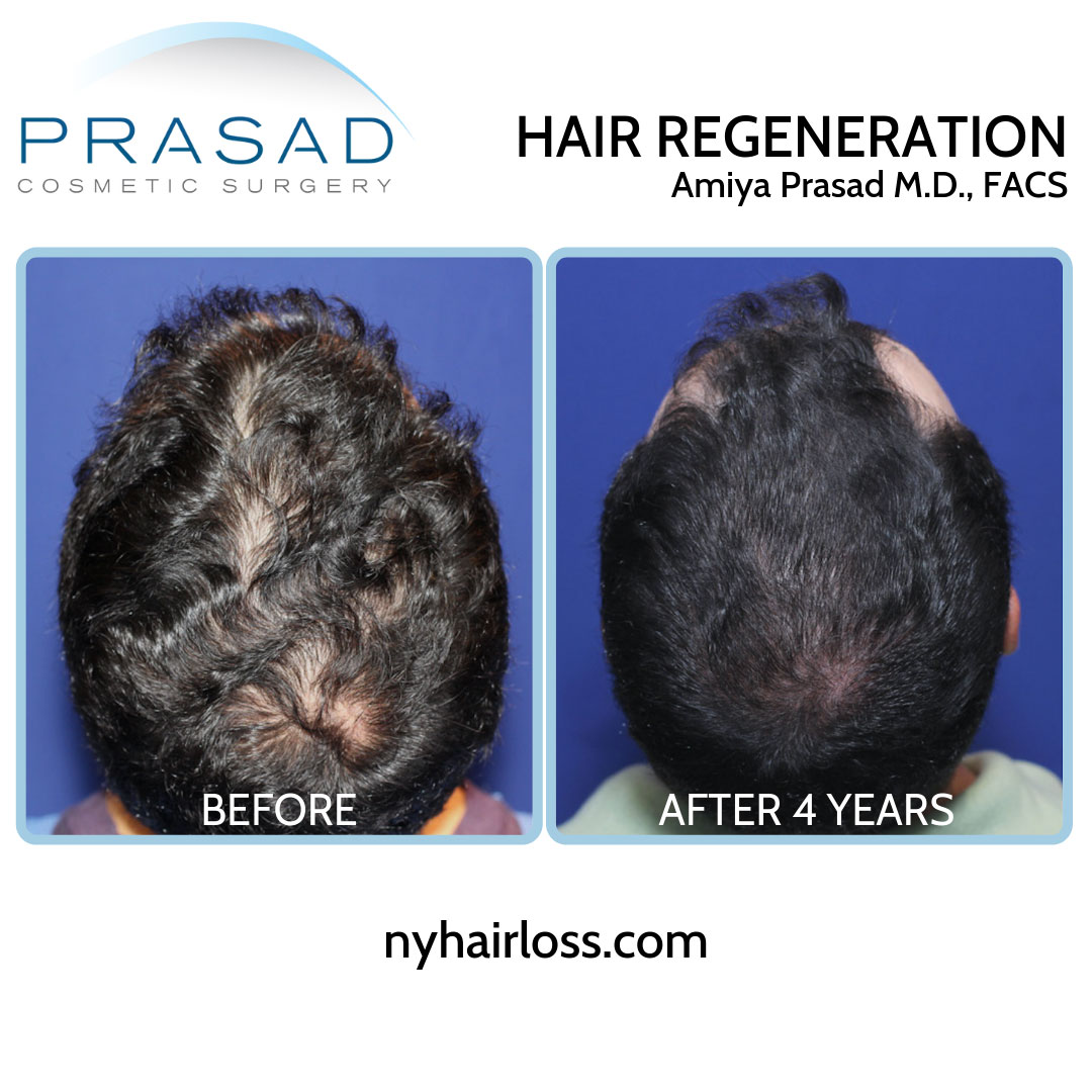 Hair Regeneration before and after 4 years results on male patient