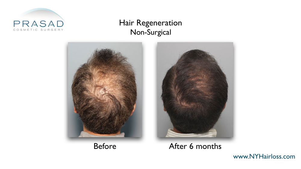 hair regeneration non-surgical hair loss treatment results before and after 6 months