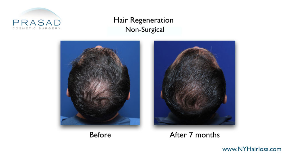 hair loss treatment for men before and after 7 months crown area