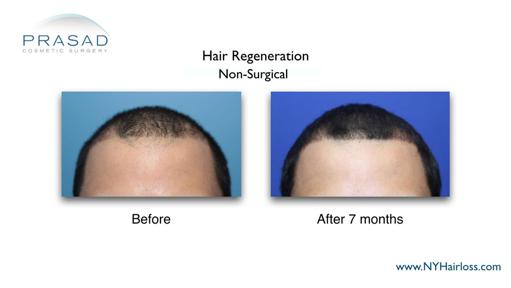before and after male pattern baldness effective treatment