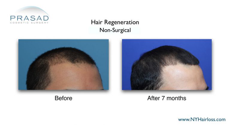 male pattern baldness treatment results
