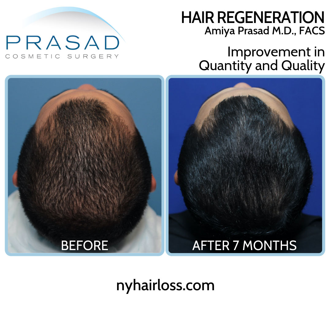 How to fix thinning hair male - before and after results