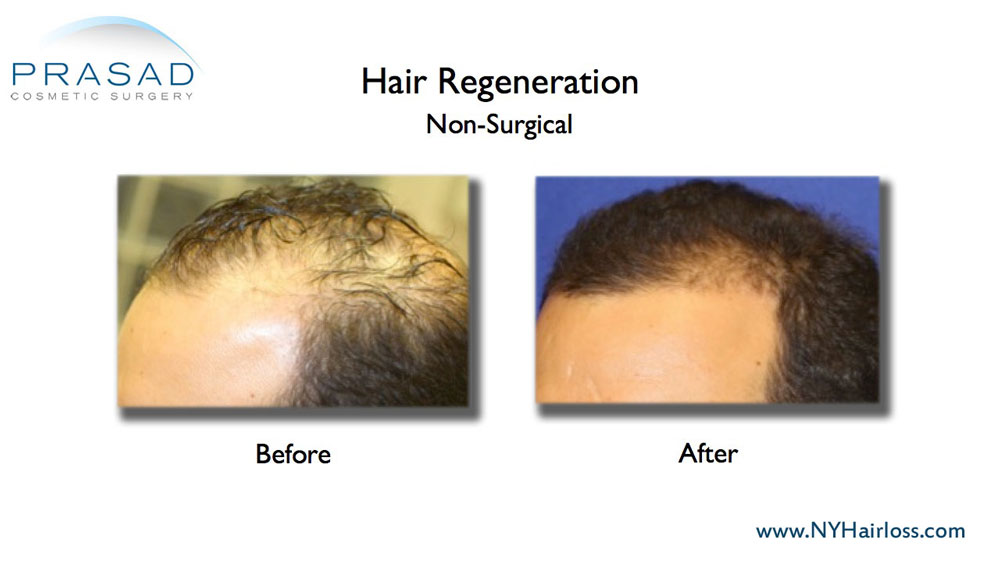 male hair loss treatment before and after results