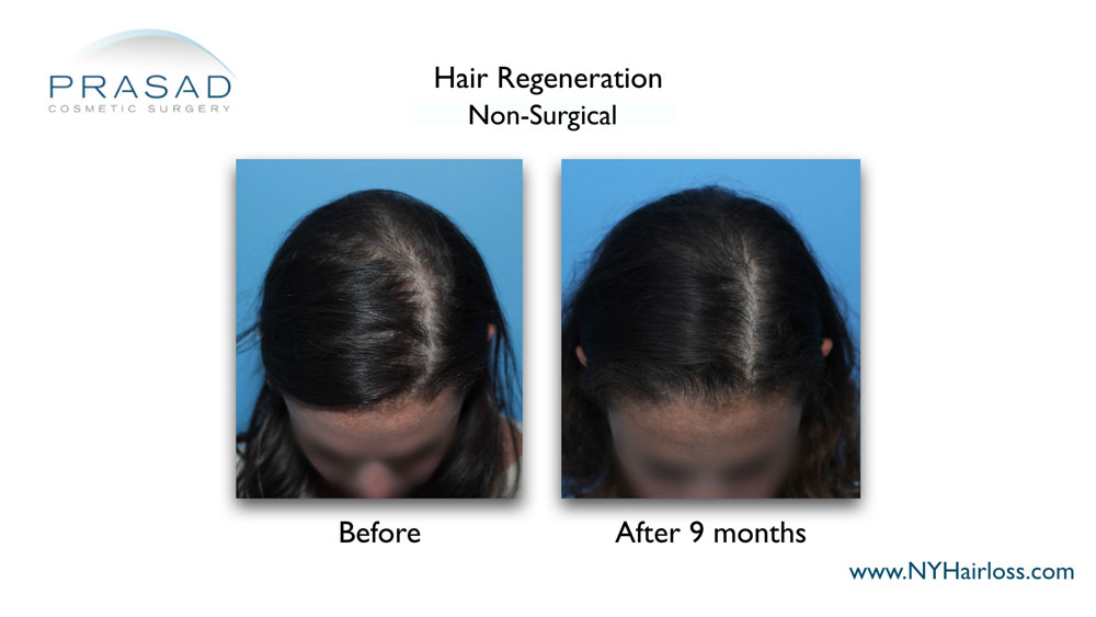 female pattern hair loss treatment before and after results
