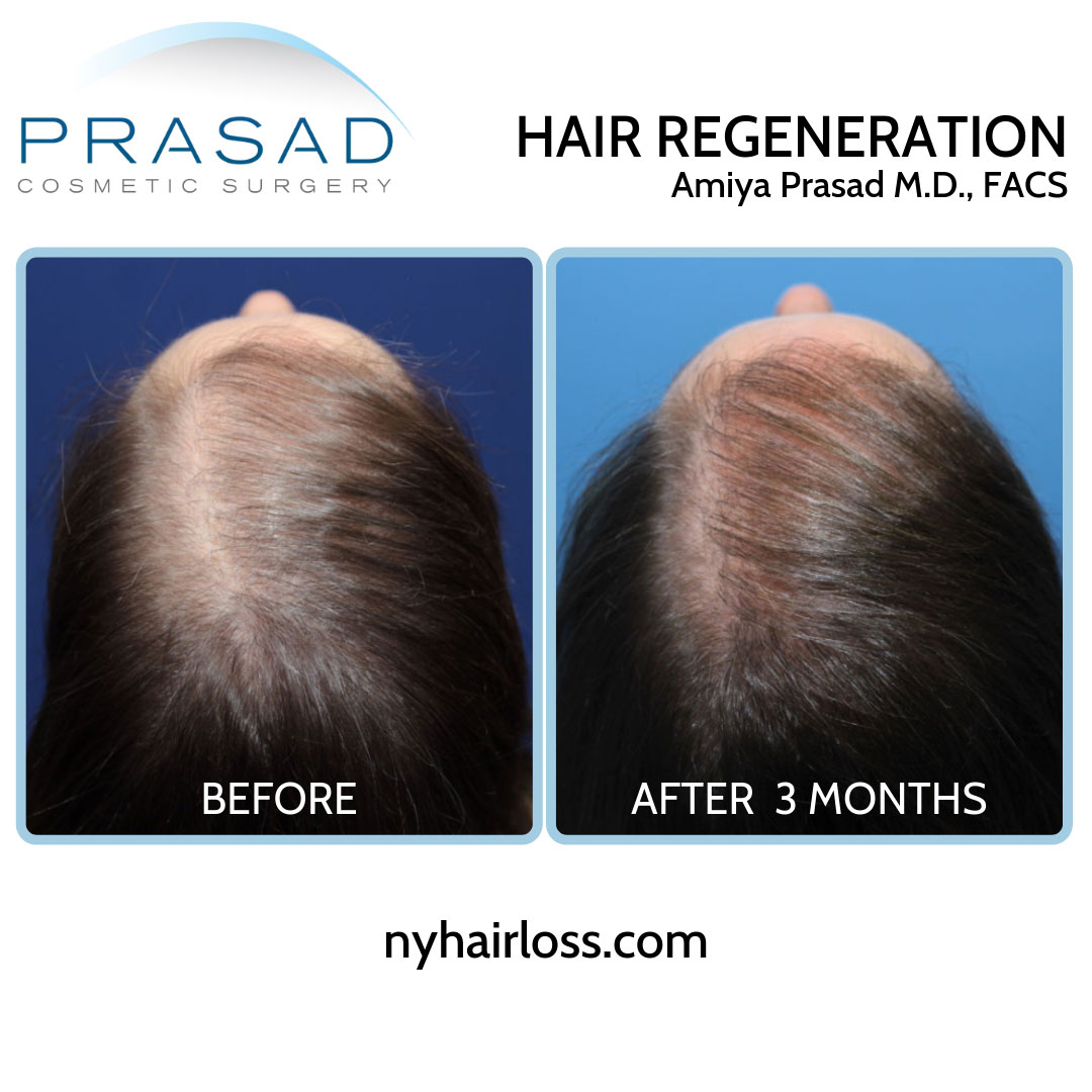 hair regrowth treatment for women before and after