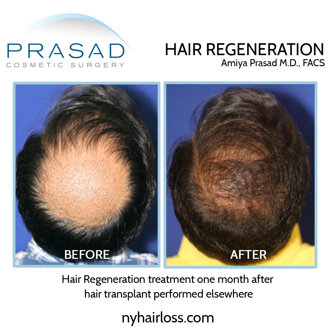 male hair regeneration treatment after hair transplant before and after results