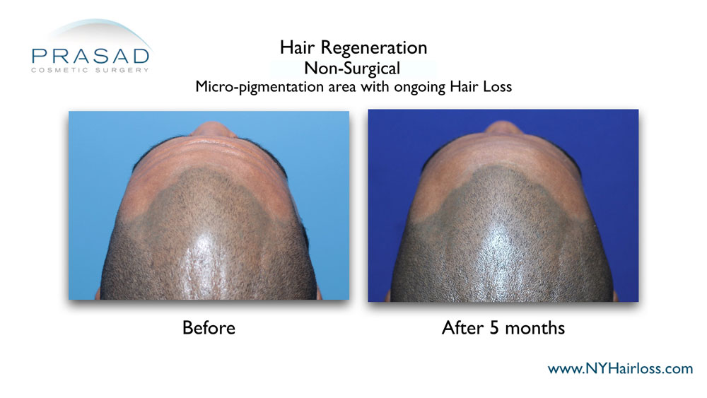 Hair Regeneration with improvement of scalp micropigmentation with ongoing hair loss top of front of scalp