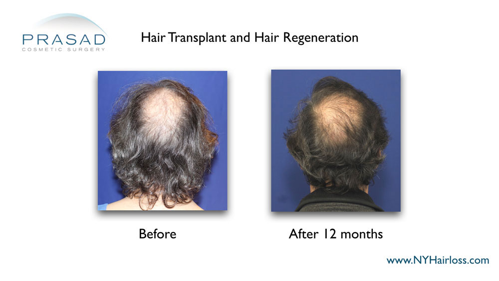 Hair Transplant and hair regeneration before and 12 months after recovery Time