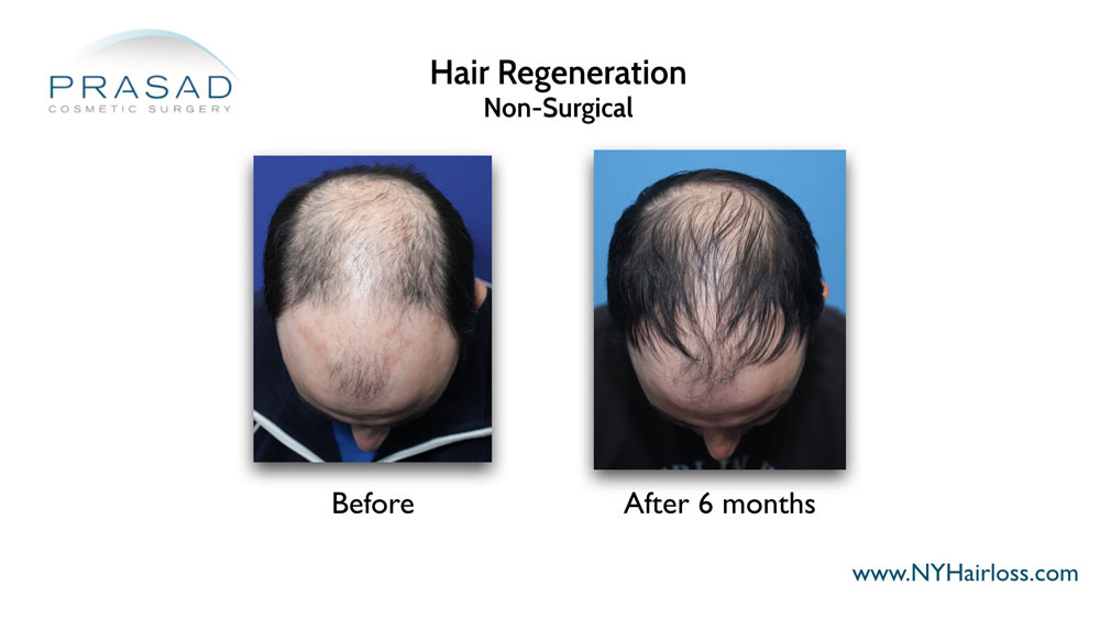 non surgical hair loss treatment before and after 6 months performed by Dr Amiya Prasad