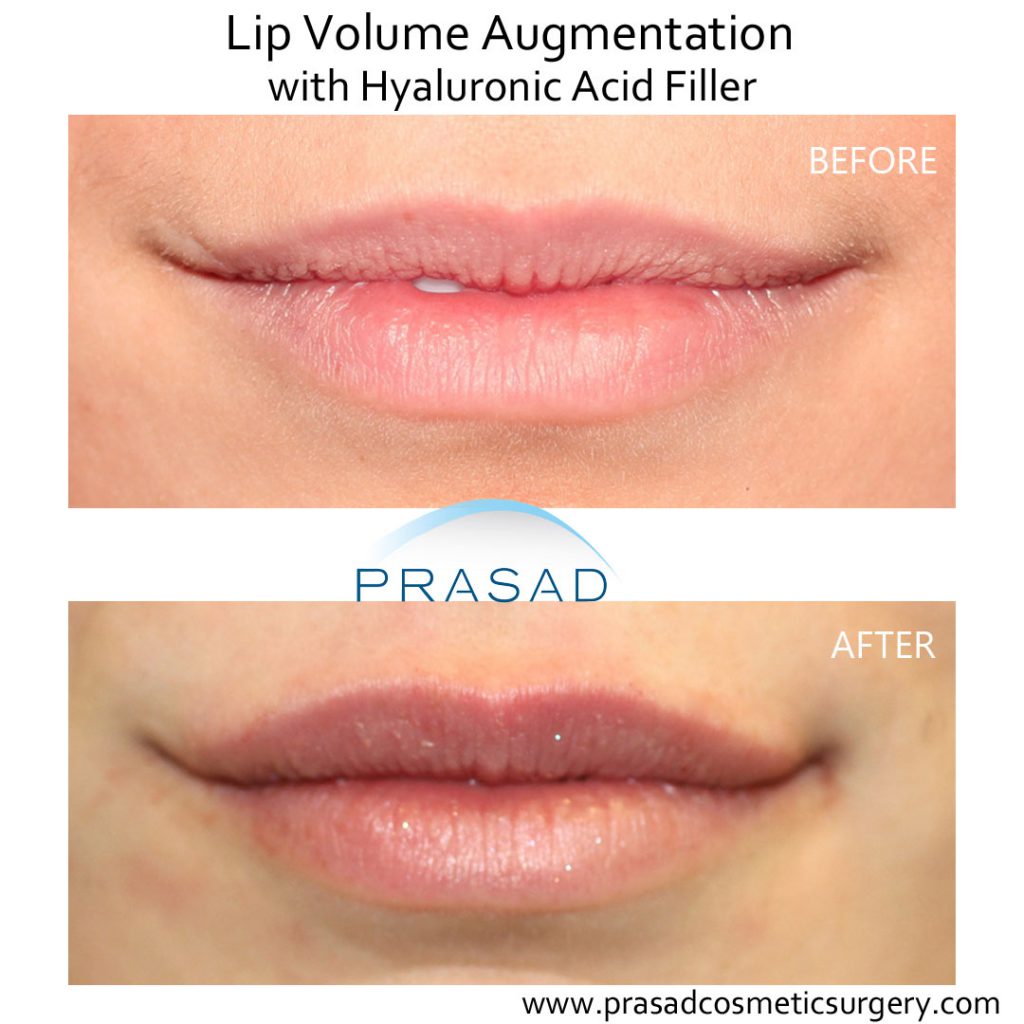 lip enhancement before and after