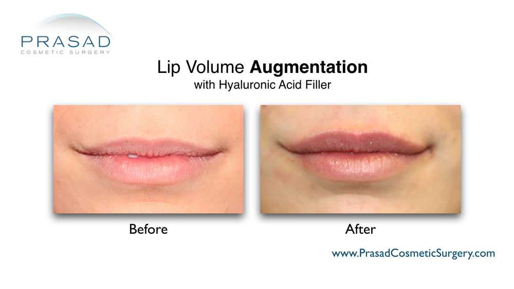 lip enhancement before and after