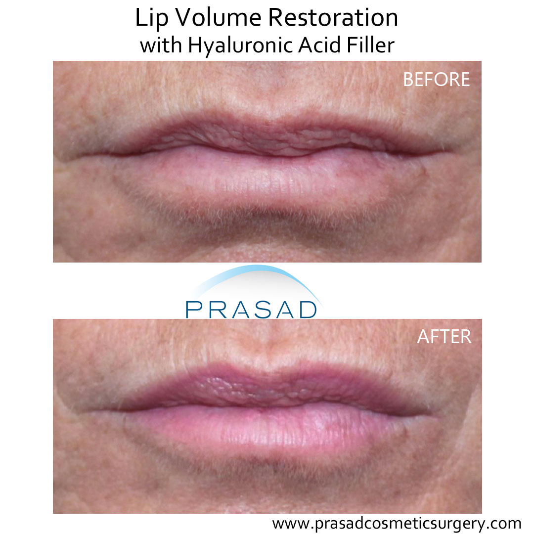 lip enhancement before and after performed at Prasad Cosmetic Surgery New York City