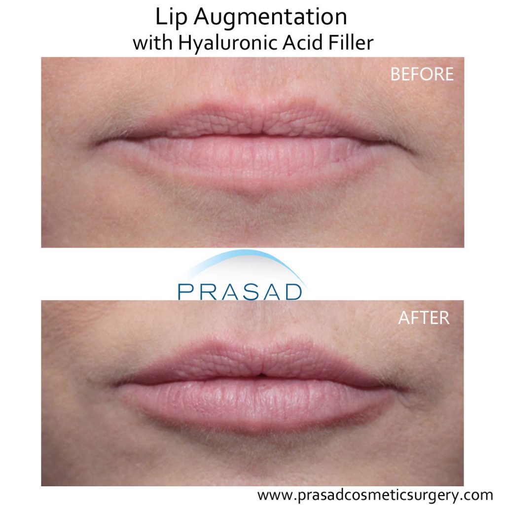 Best Lip Enhancement  Lip Fillers in NYC and Garden City