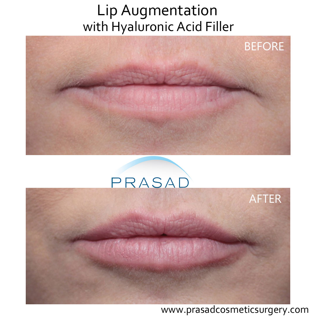 lip fillers before and after performed by Dr. Amiya Prasad