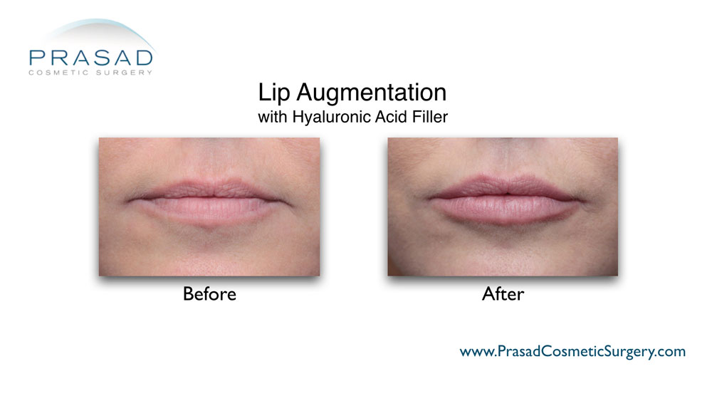 lip fillers before and after performed by Dr. Amiya Prasad