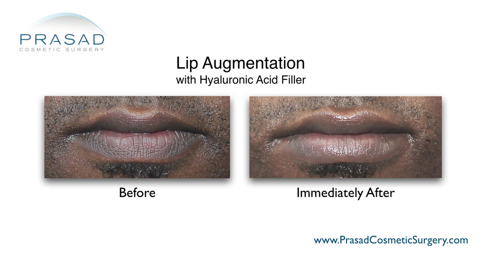 Juvederm lips before and after performed in Prasad Cosmetic Surgery Garden City