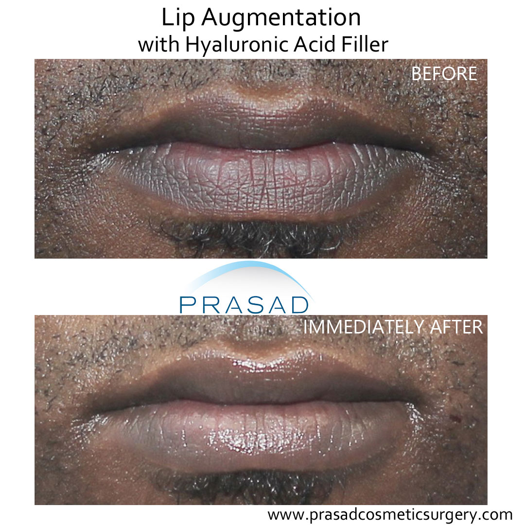 hyaluronic acid lip fillers before and after performed in Prasad Cosmetic Surgery Garden City