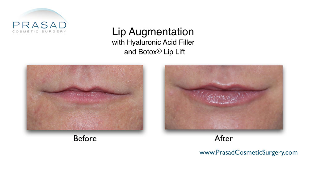 Juvederm lips before and after performed by Dr Amiya Prasad