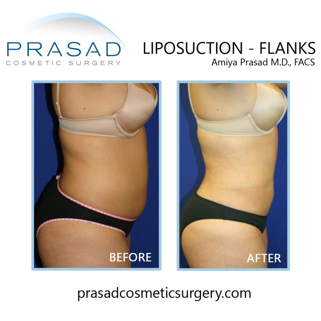 Before & After Tummy tuck with lipo to flanks and thighs - Dr