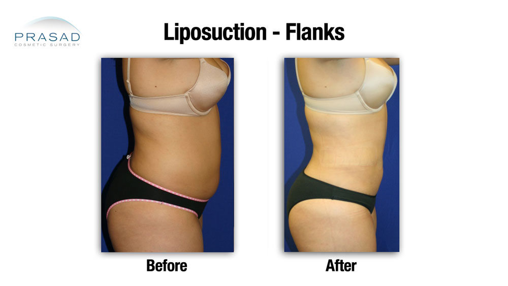 flanks liposuction before and after