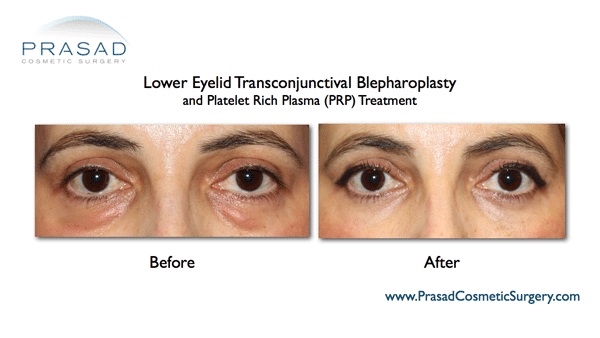 lower blepharoplasty and PRP before and after