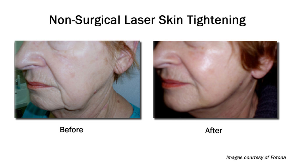 before and after Non-ablative laser facial resurfacing on older female