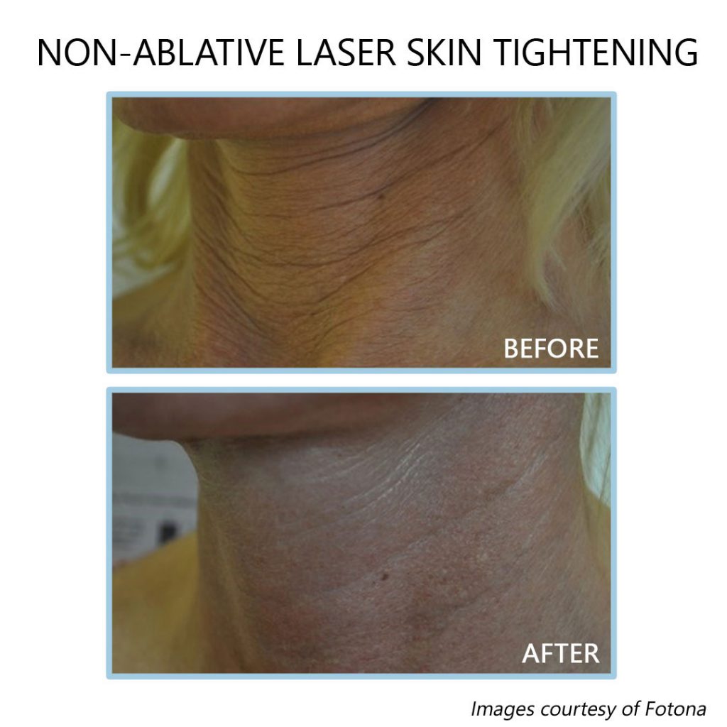 Body Laser Skin Tightening - NYC and Long Island New York