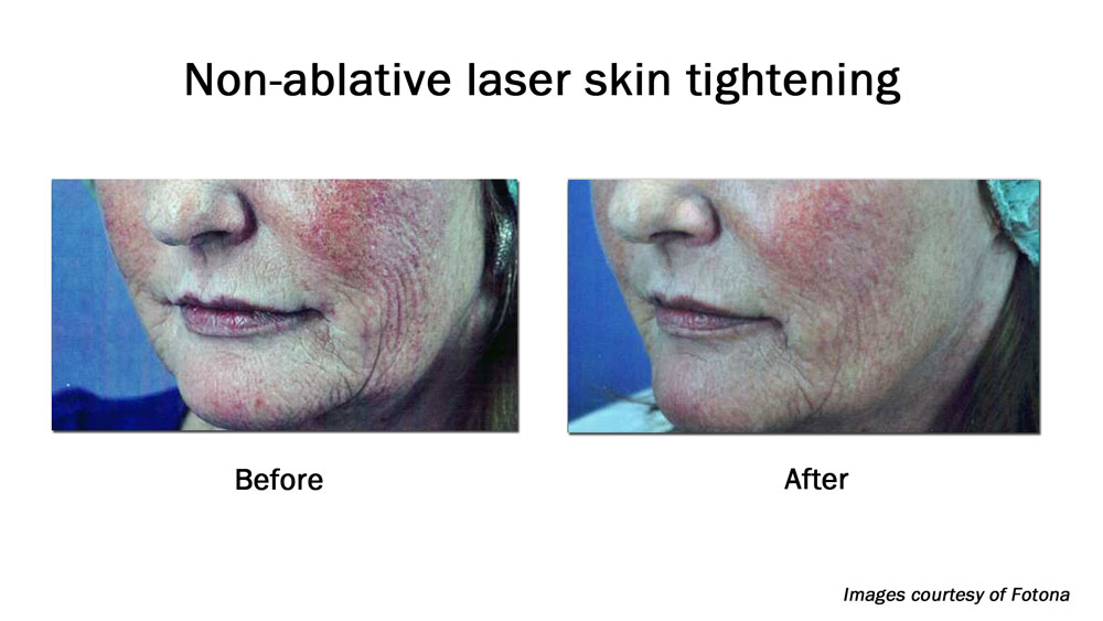 before and after Ablative laser facial resurfacing / facial skin tightening results