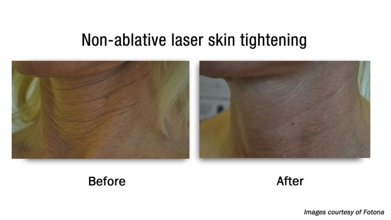 Body Laser Skin Tightening Nyc And Long Island New York