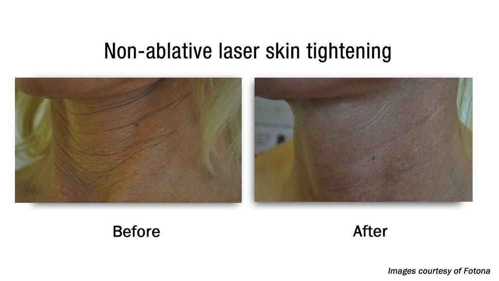 Non-ablative laser skin tightening before and after