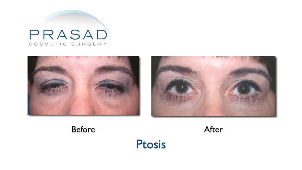 eyelid ptosis surgery before and after